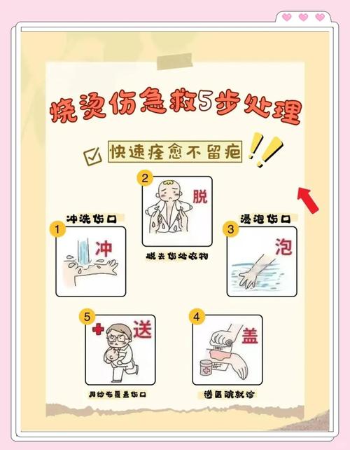 烫伤康复训练介入?关节活动度保护